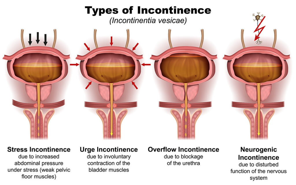 Common Urinary Conditions in Women