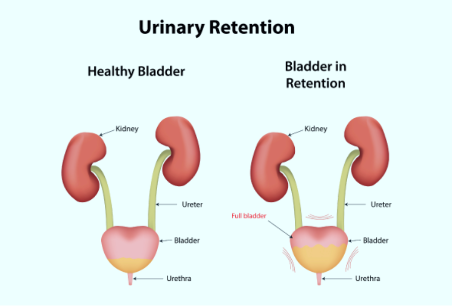 Acute Urinary Retention
